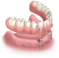Implant Retained Denture at the Smiles Centre Swindon Dental
