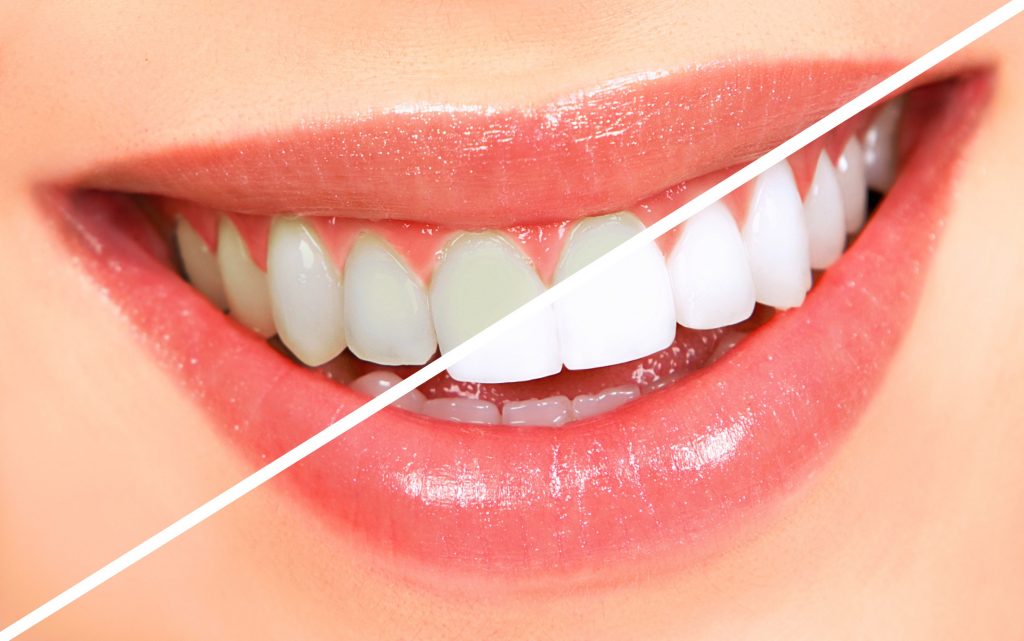 HOW LONG DOES TEETH WHITENING TAKE ?
