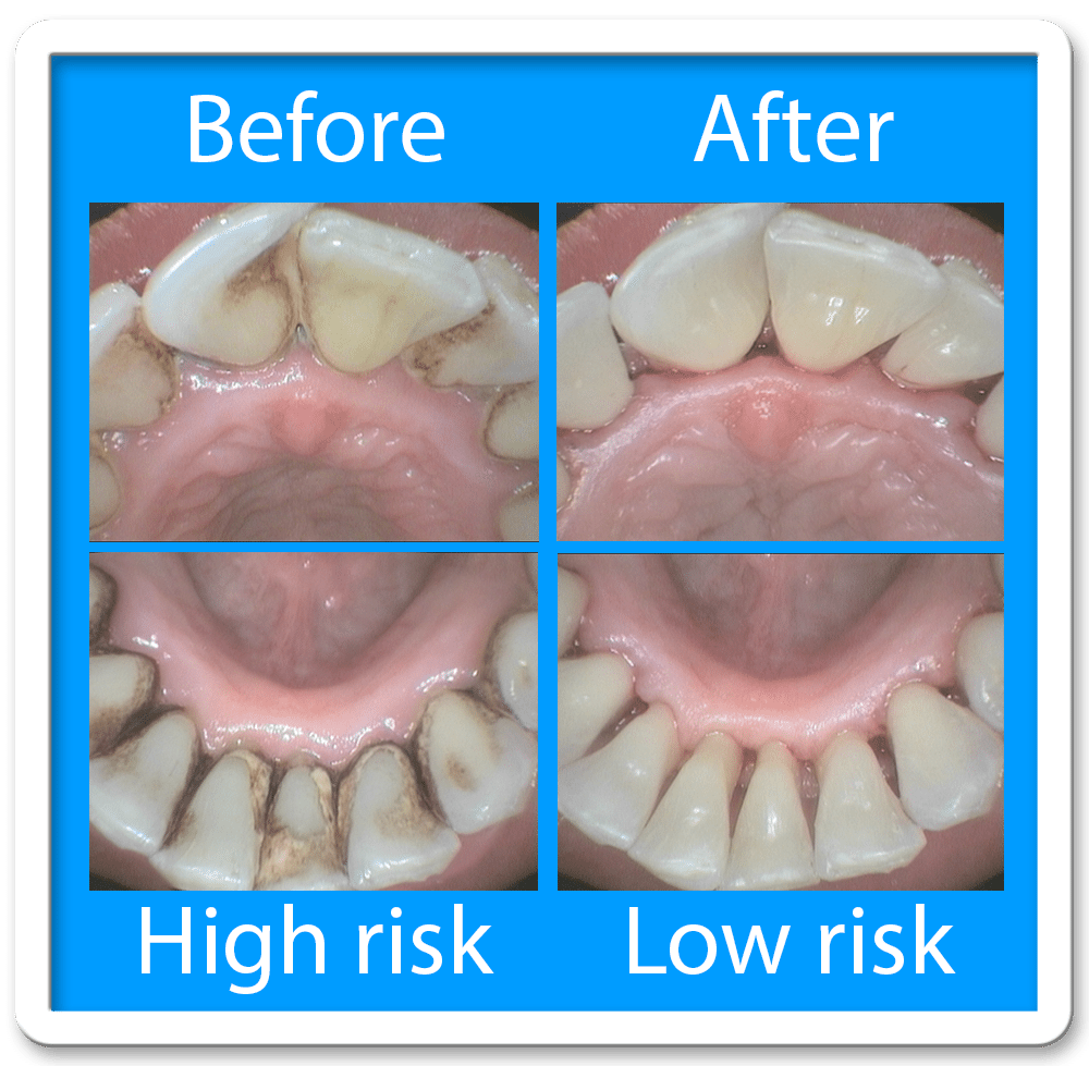 HYGIENE Before and After big swindon dentist