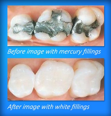 amalgam removal