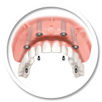 FIXED ARCH IMPLANT