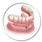 REMOVEABLE DENTURE IMPLANT