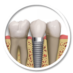 SINGLE TOOTH IMPLANT