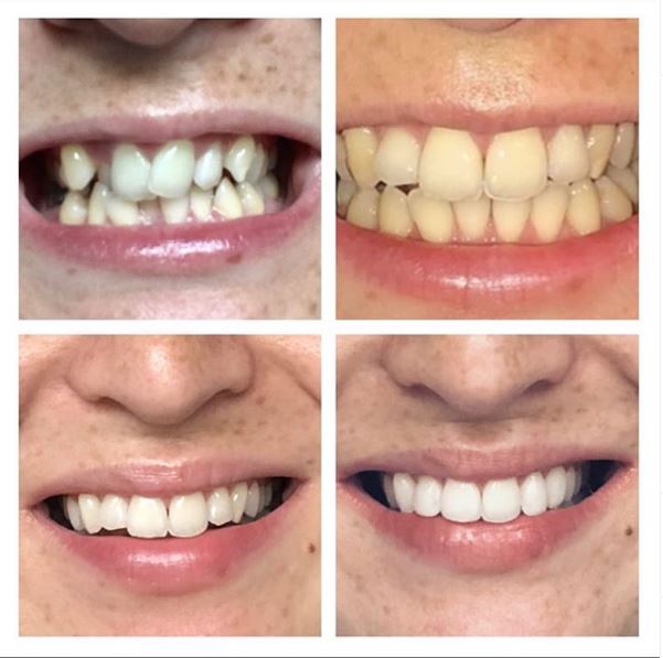 teeth straightening results