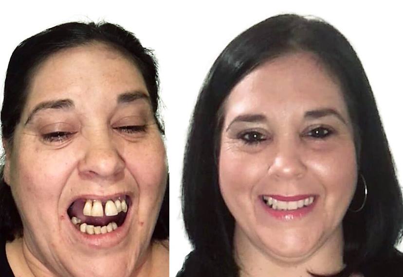 dentures or implants